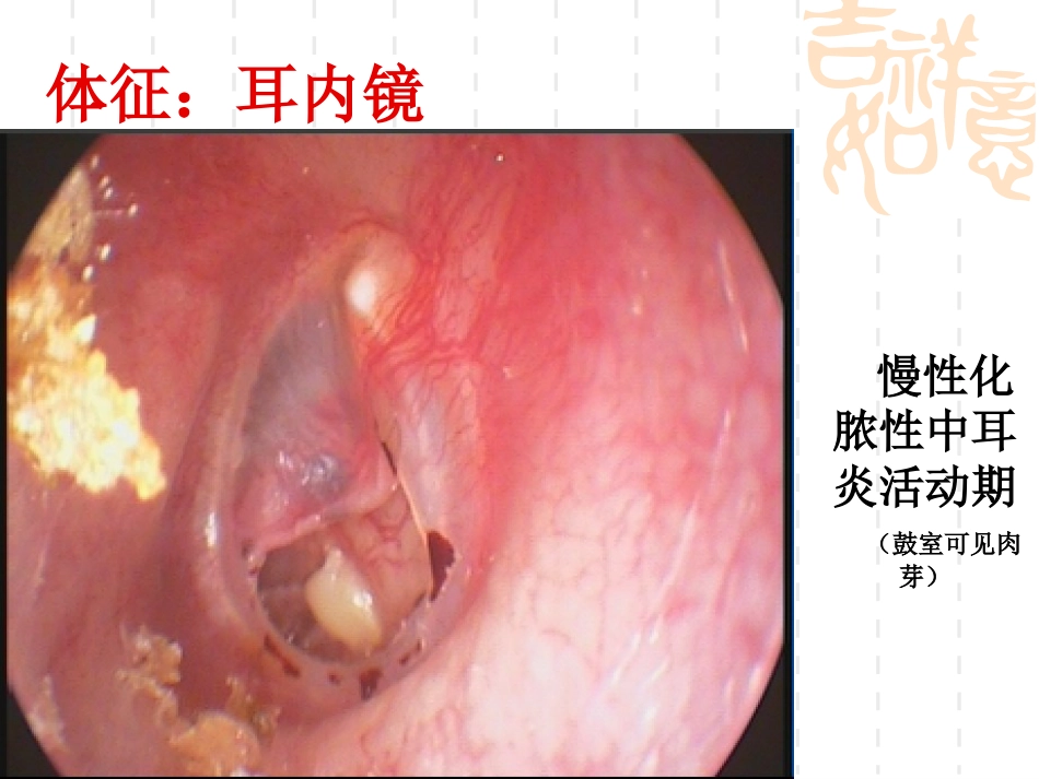 慢性化脓性中耳炎(5)_第8页