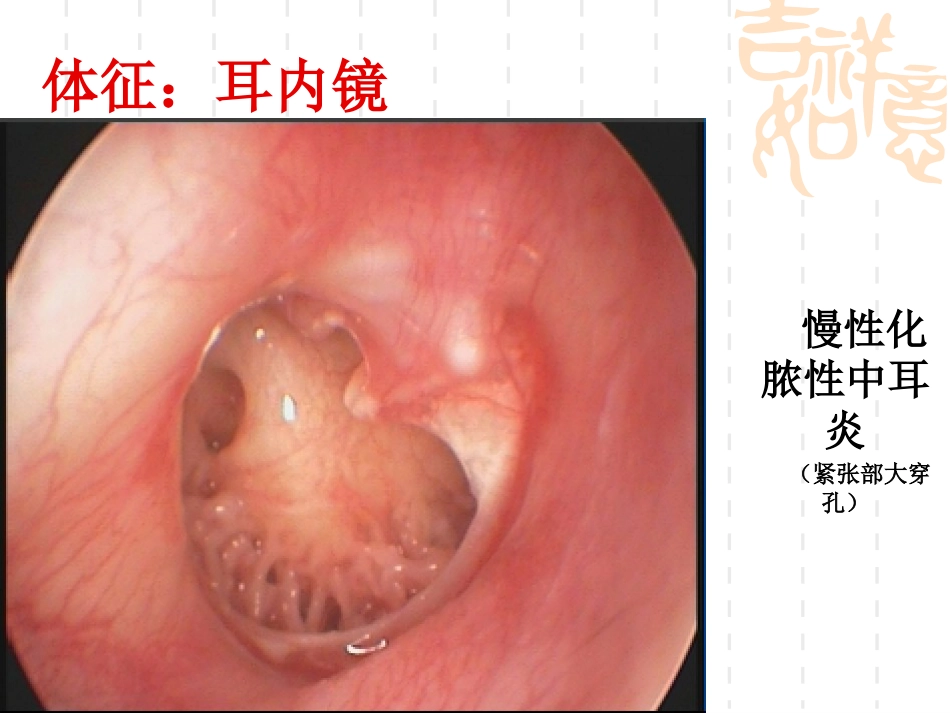 慢性化脓性中耳炎(5)_第9页