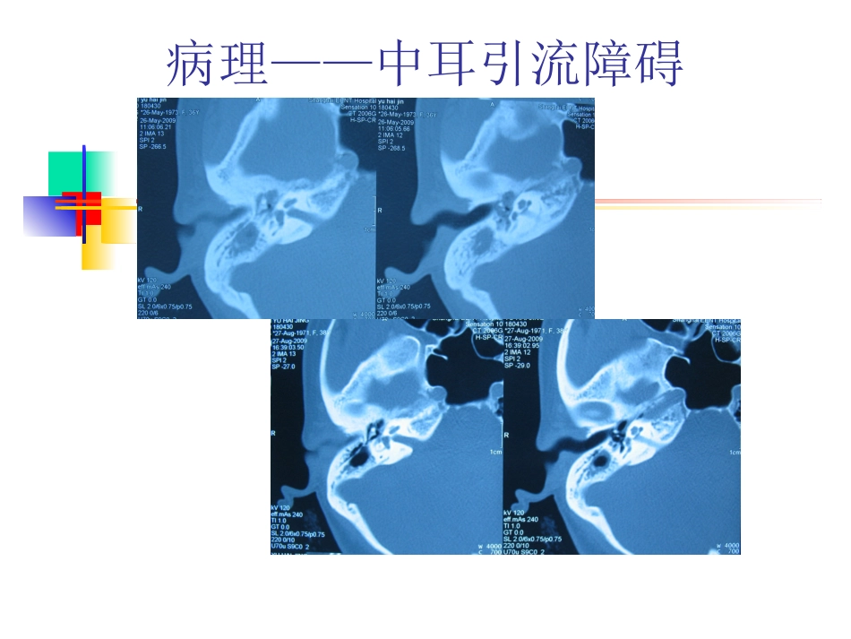 慢性化脓性中耳炎(6)_第10页