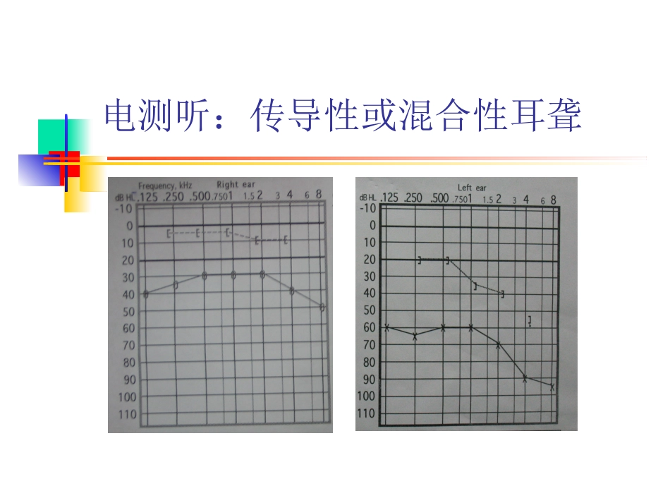 慢性化脓性中耳炎(6)_第14页