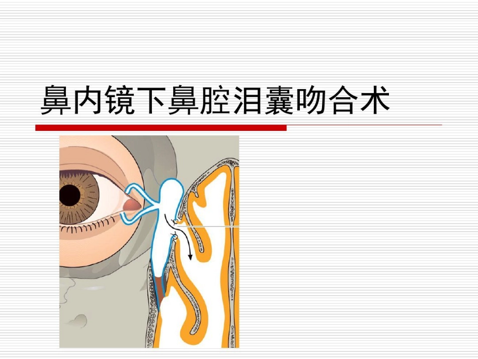 鼻内镜鼻腔泪囊吻合术PPT医学共23页_第1页
