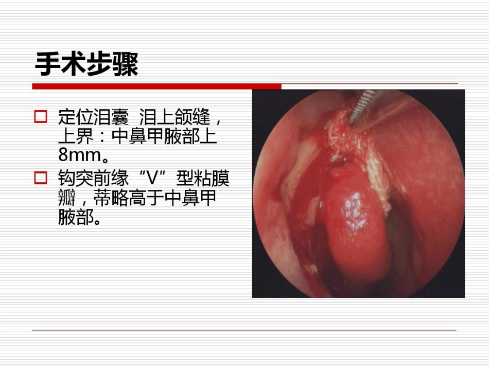 鼻内镜鼻腔泪囊吻合术PPT医学共23页_第14页