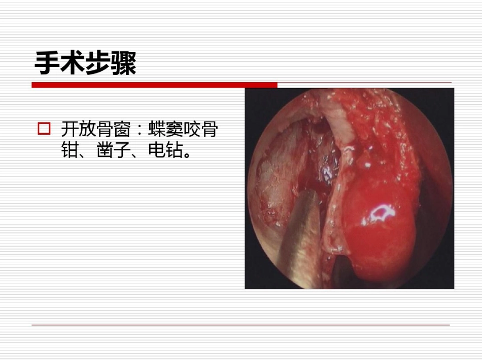 鼻内镜鼻腔泪囊吻合术PPT医学共23页_第15页