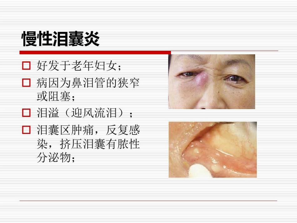鼻内镜鼻腔泪囊吻合术PPT医学共23页_第3页