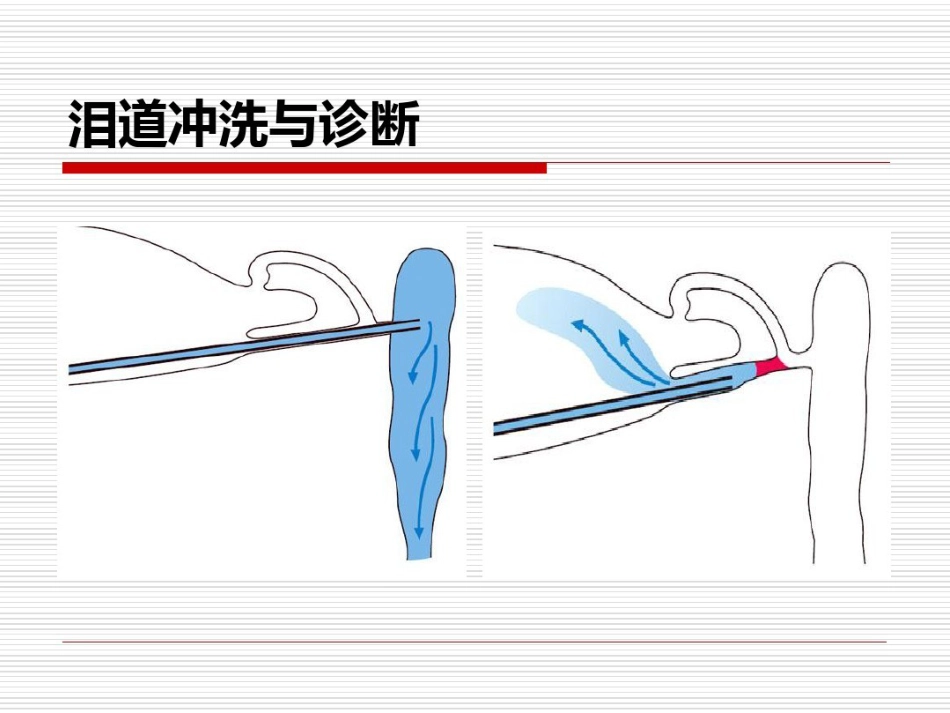 鼻内镜鼻腔泪囊吻合术PPT医学共23页_第4页