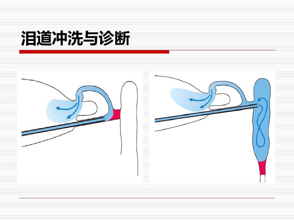 鼻内镜鼻腔泪囊吻合术PPT医学共23页_第5页