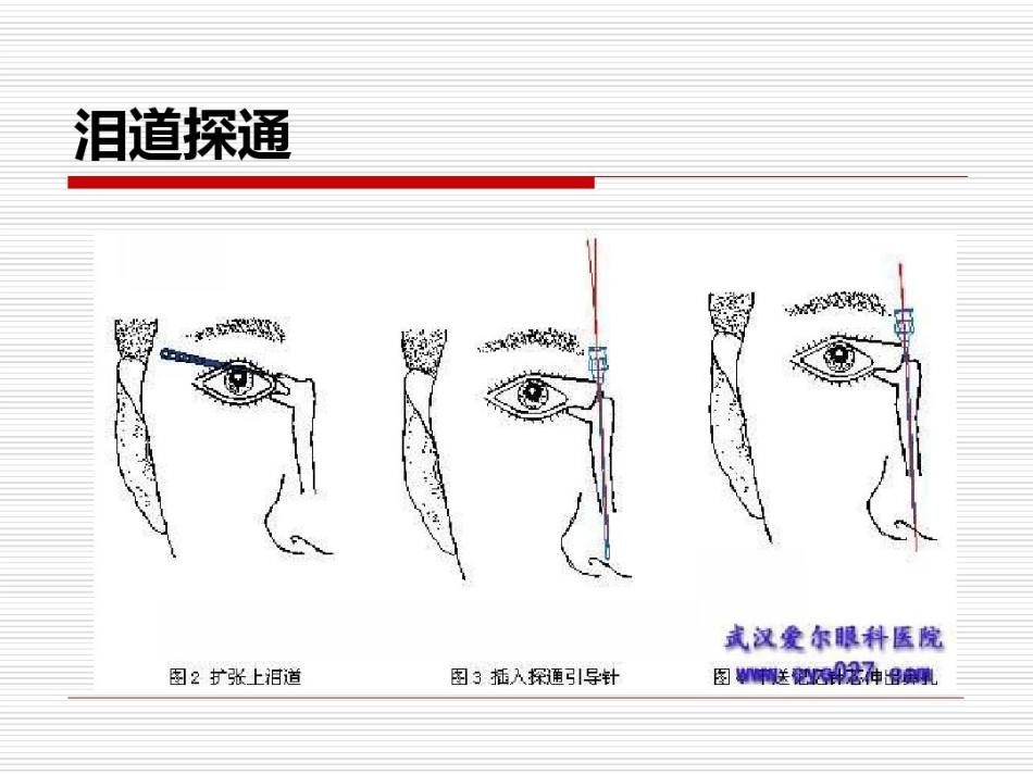 鼻内镜鼻腔泪囊吻合术PPT医学共23页_第6页