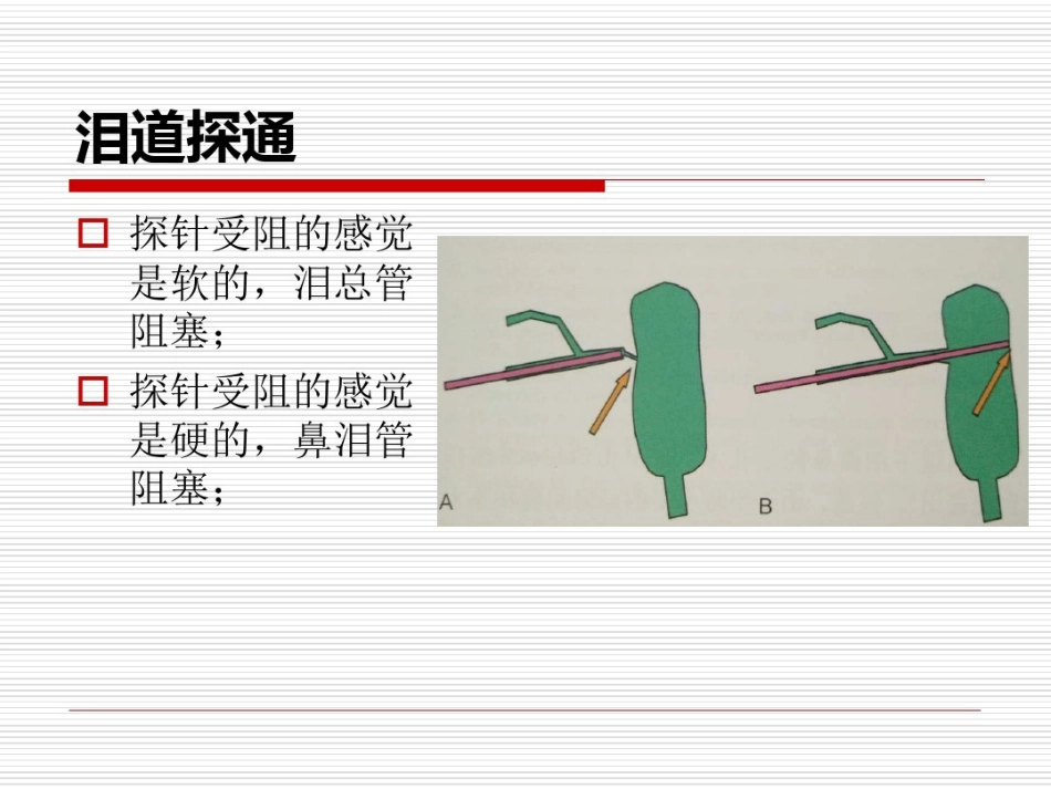 鼻内镜鼻腔泪囊吻合术PPT医学共23页_第7页