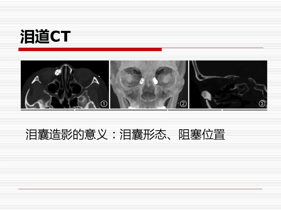 鼻内镜鼻腔泪囊吻合术PPT医学共23页_第9页