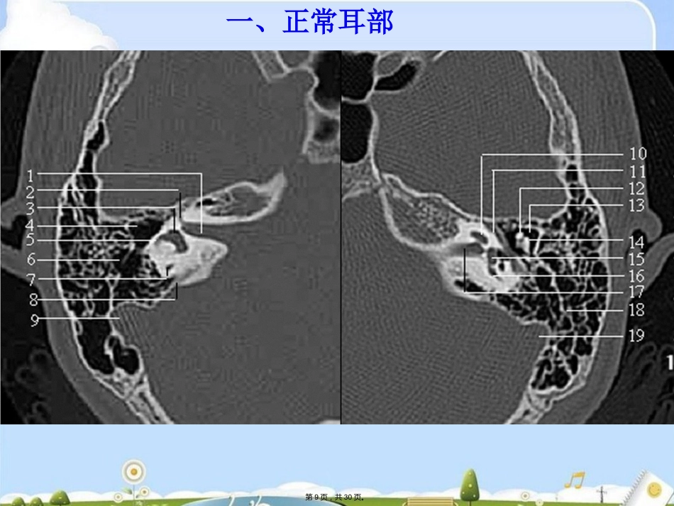 耳部疾病(共30张PPT)_第9页