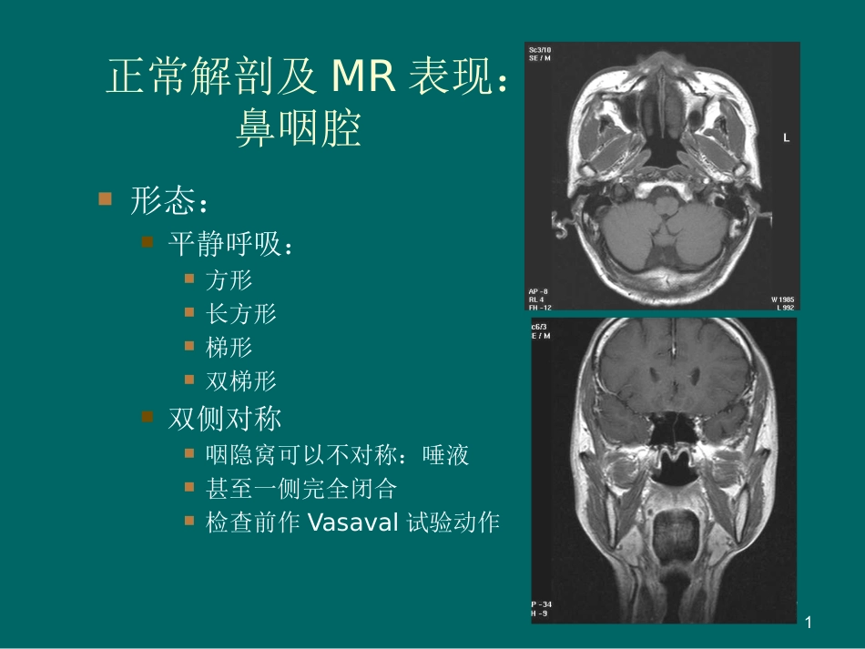 鼻咽癌MR诊断2018_第1页