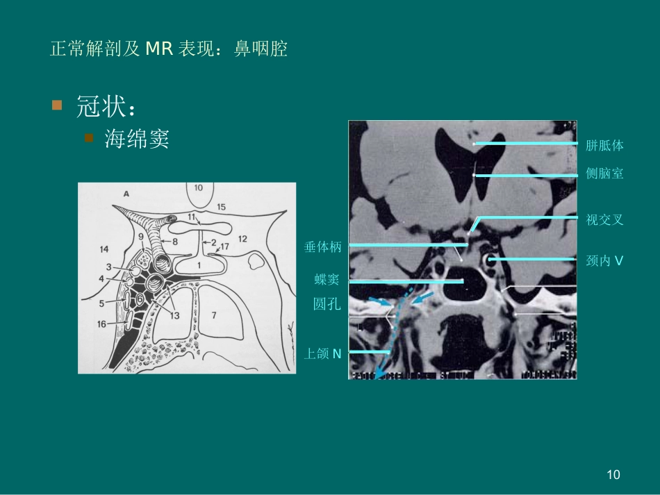 鼻咽癌MR诊断2018_第10页