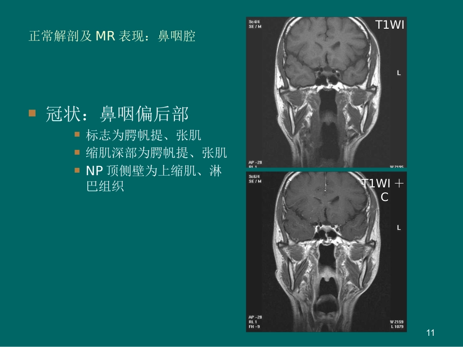 鼻咽癌MR诊断2018_第11页