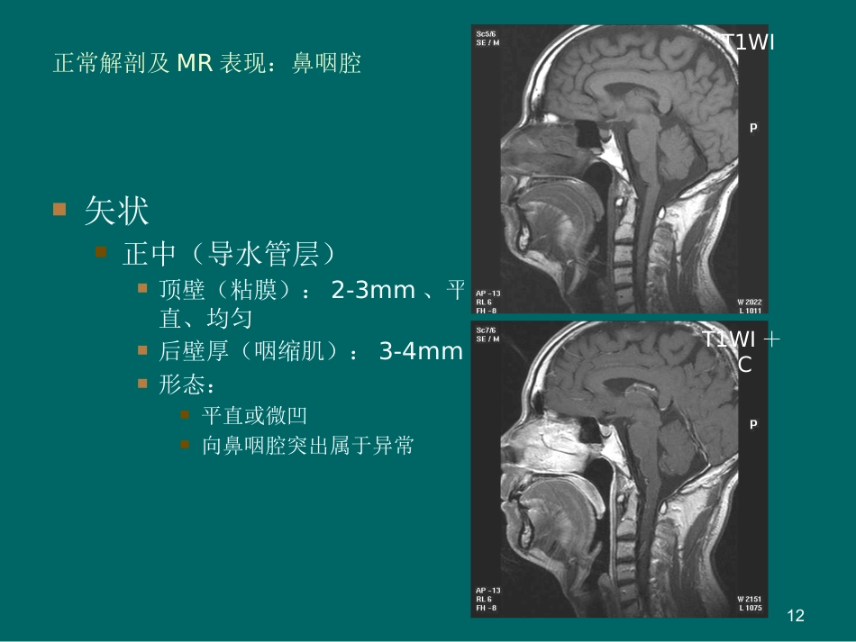 鼻咽癌MR诊断2018_第12页