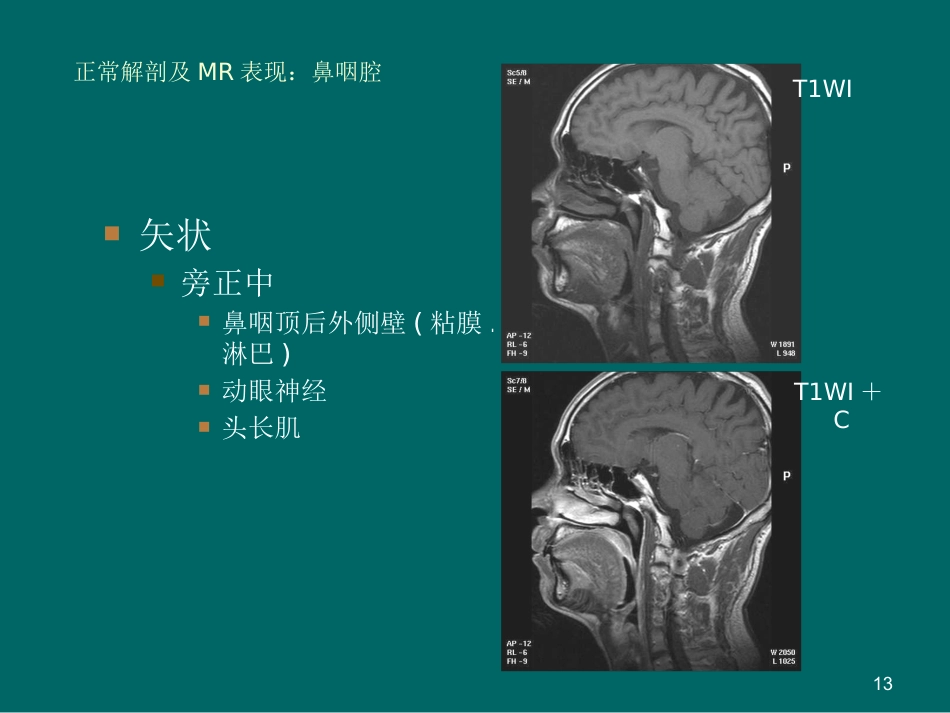 鼻咽癌MR诊断2018_第13页