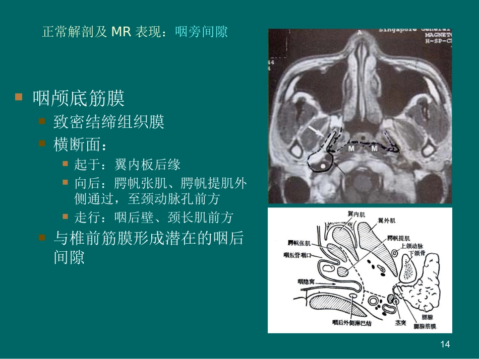 鼻咽癌MR诊断2018_第14页