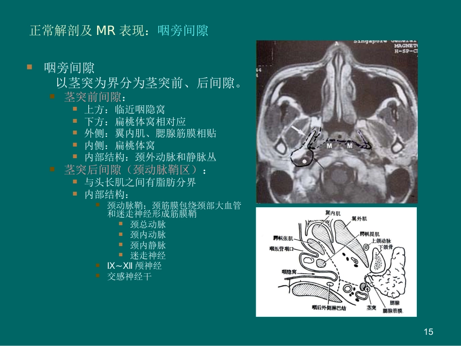 鼻咽癌MR诊断2018_第15页