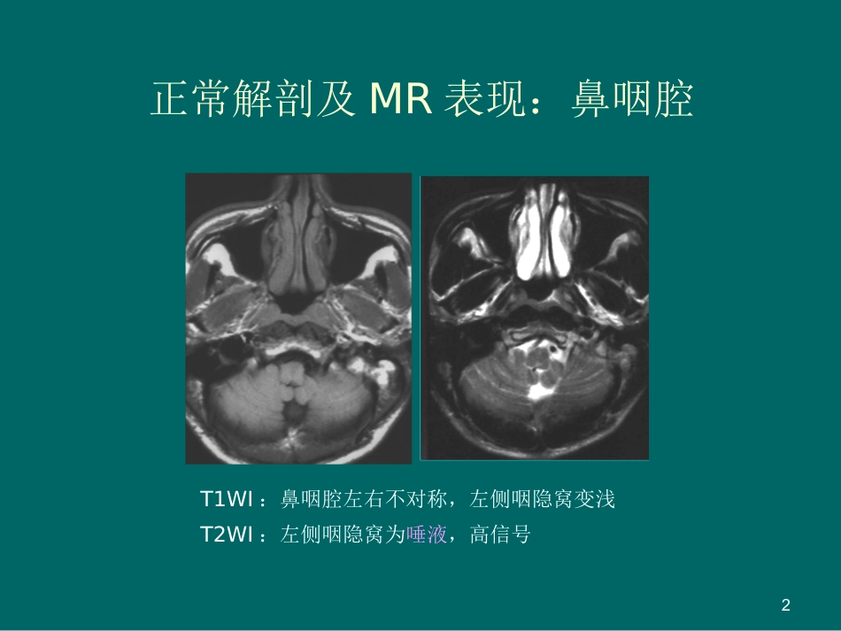 鼻咽癌MR诊断2018_第2页