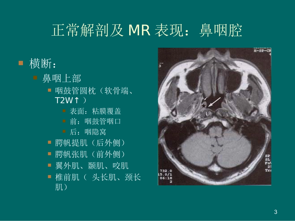 鼻咽癌MR诊断2018_第3页