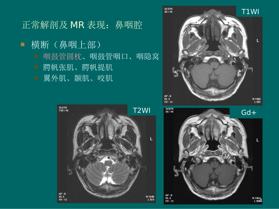 鼻咽癌MR诊断2018_第4页