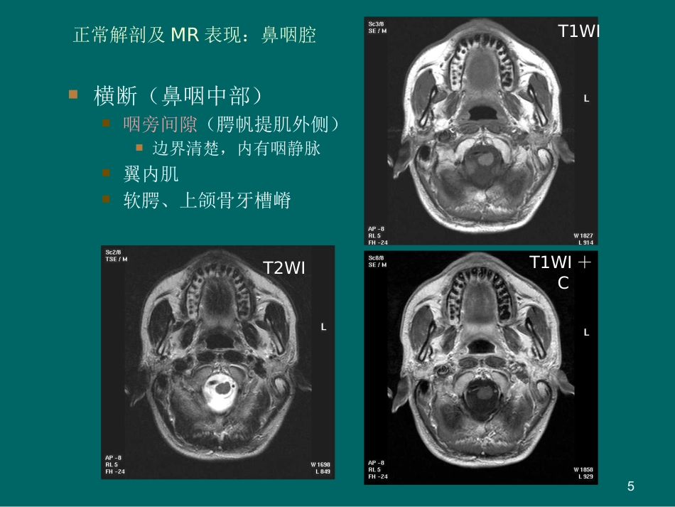 鼻咽癌MR诊断2018_第5页