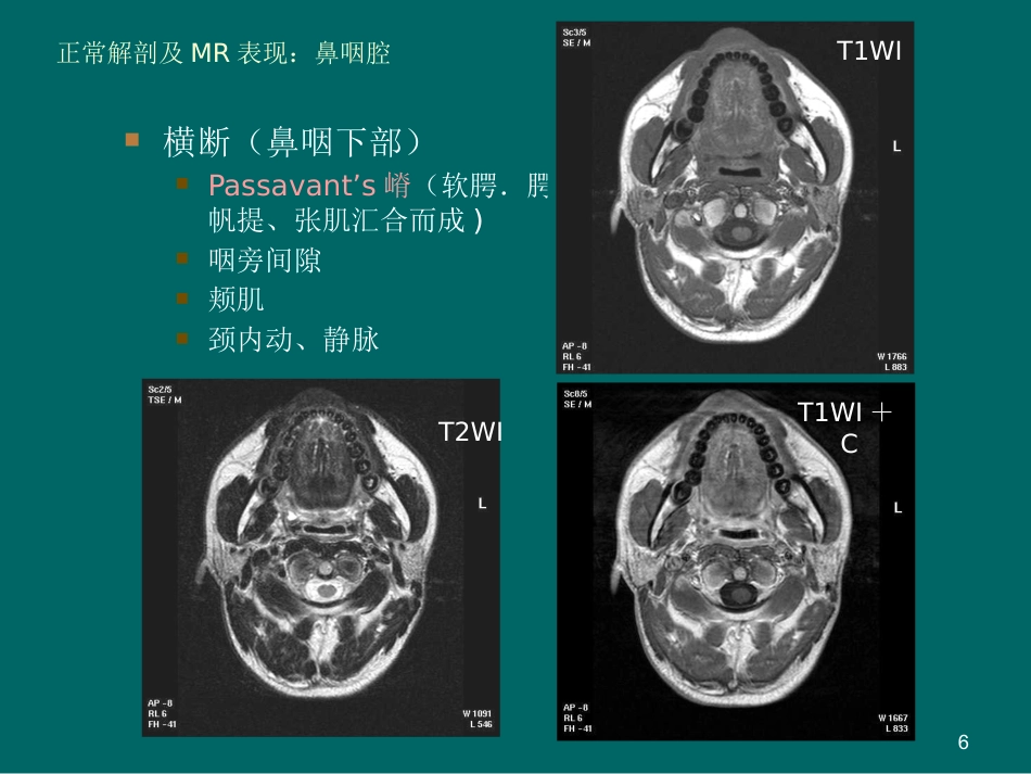 鼻咽癌MR诊断2018_第6页