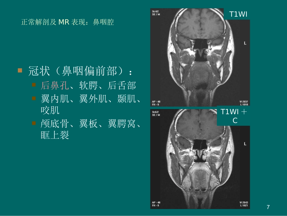 鼻咽癌MR诊断2018_第7页