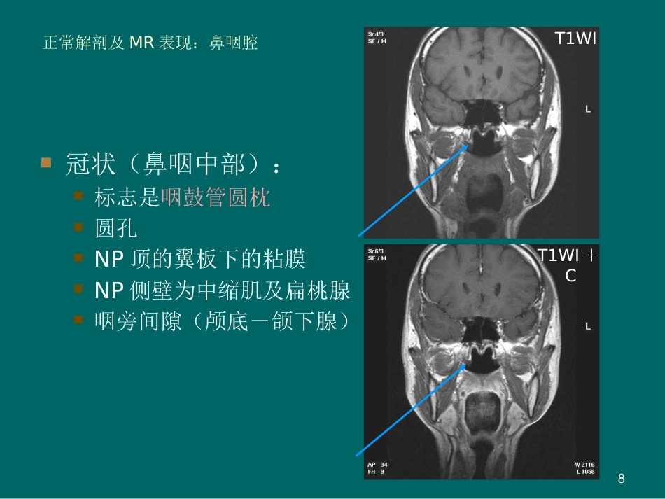 鼻咽癌MR诊断2018_第8页