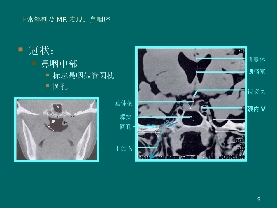 鼻咽癌MR诊断2018_第9页