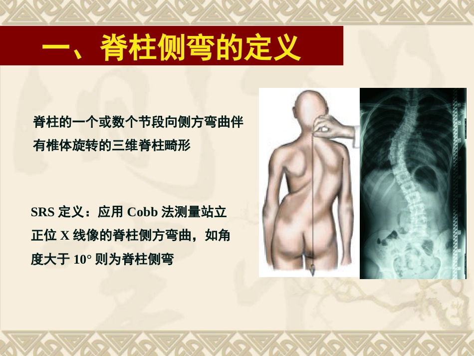 脊柱侧弯的治疗与对策_第2页
