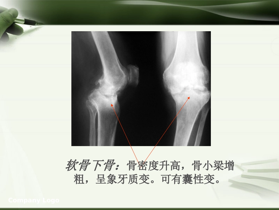 针刀治疗膝关节骨性关节炎PPT_第13页