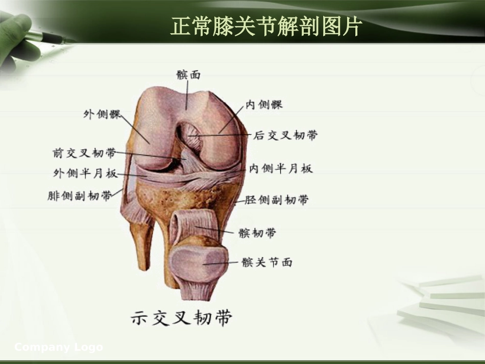 针刀治疗膝关节骨性关节炎PPT_第15页