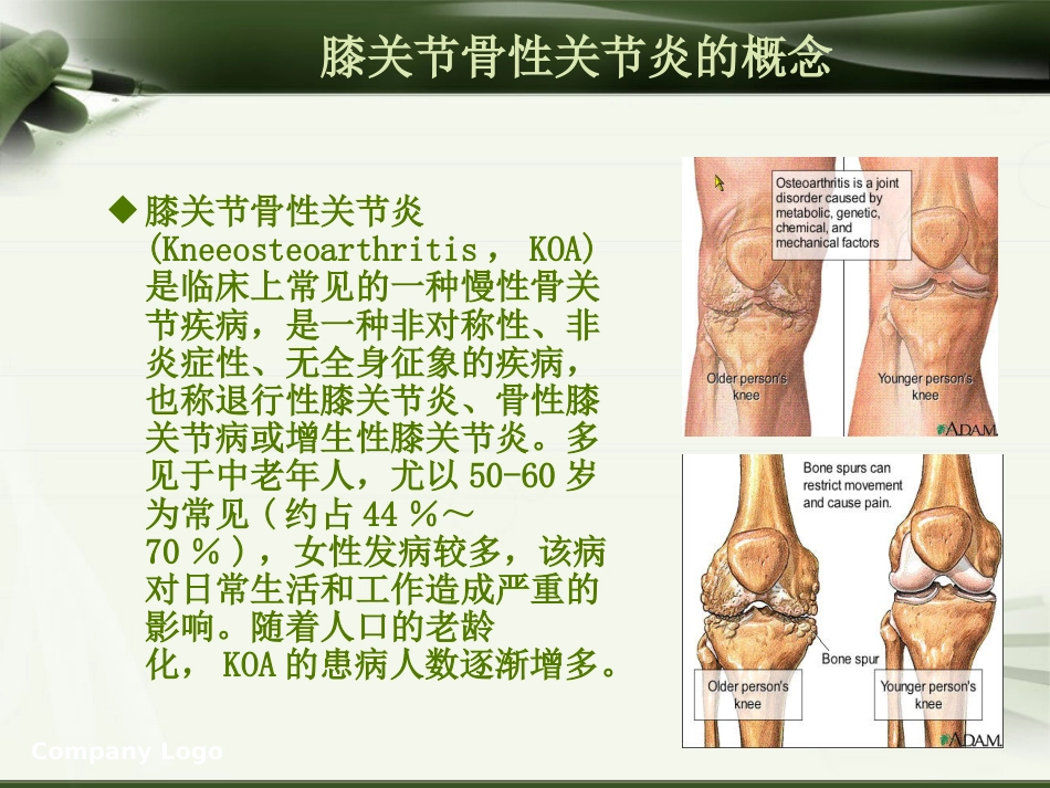 针刀治疗膝关节骨性关节炎PPT_第2页