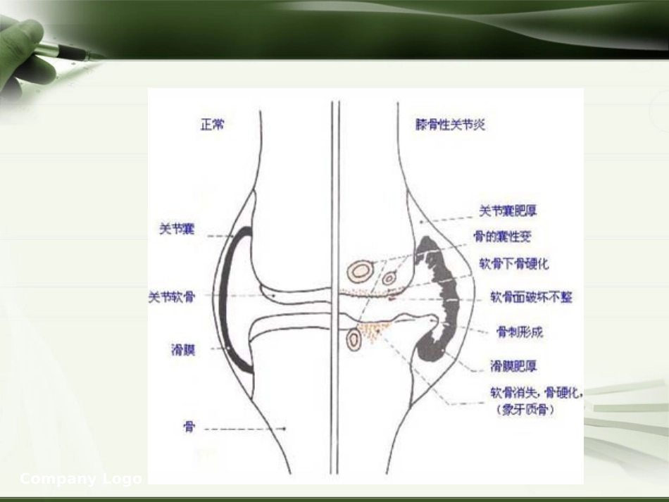 针刀治疗膝关节骨性关节炎PPT_第5页