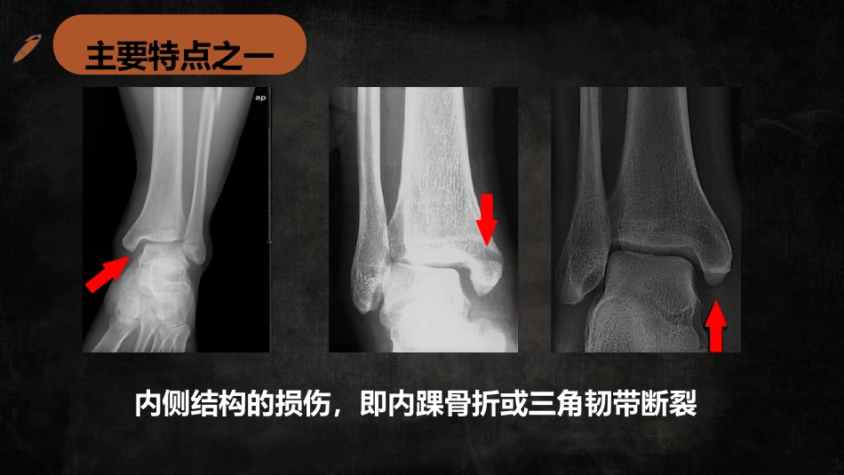 特殊类型踝关节汇总_第11页