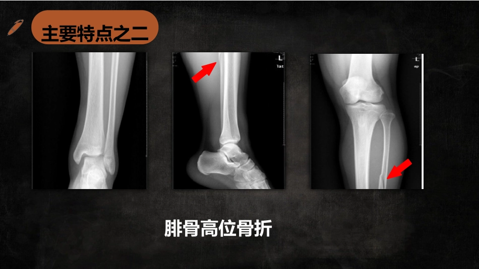 特殊类型踝关节汇总_第12页