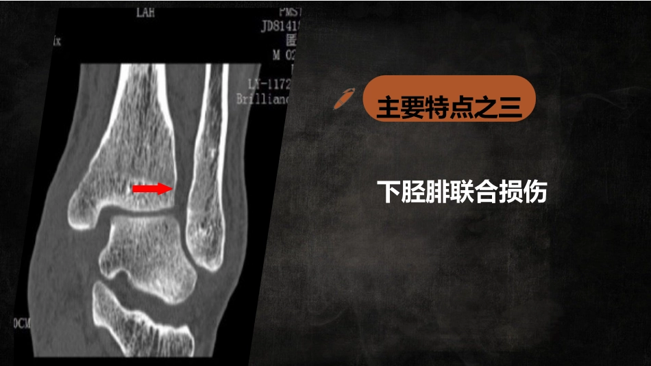 特殊类型踝关节汇总_第13页