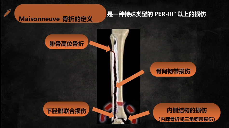 特殊类型踝关节汇总_第6页