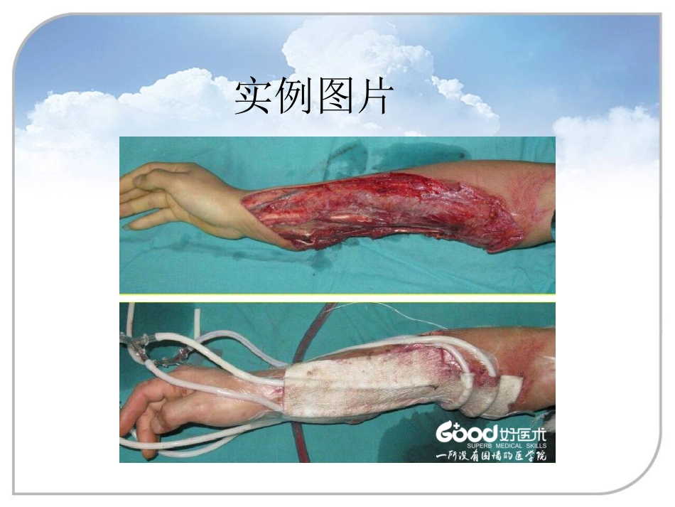 负压封闭引流技术在骨科中的应用_第4页
