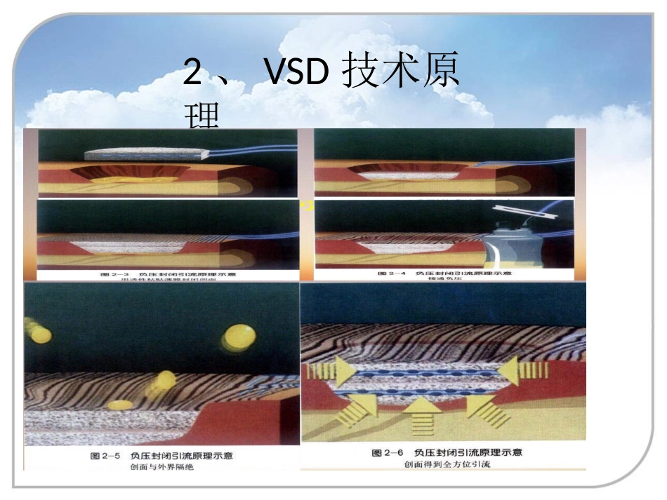 负压封闭引流技术在骨科中的应用_第5页