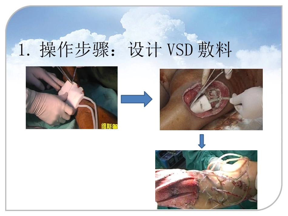 负压封闭引流技术在骨科中的应用_第8页