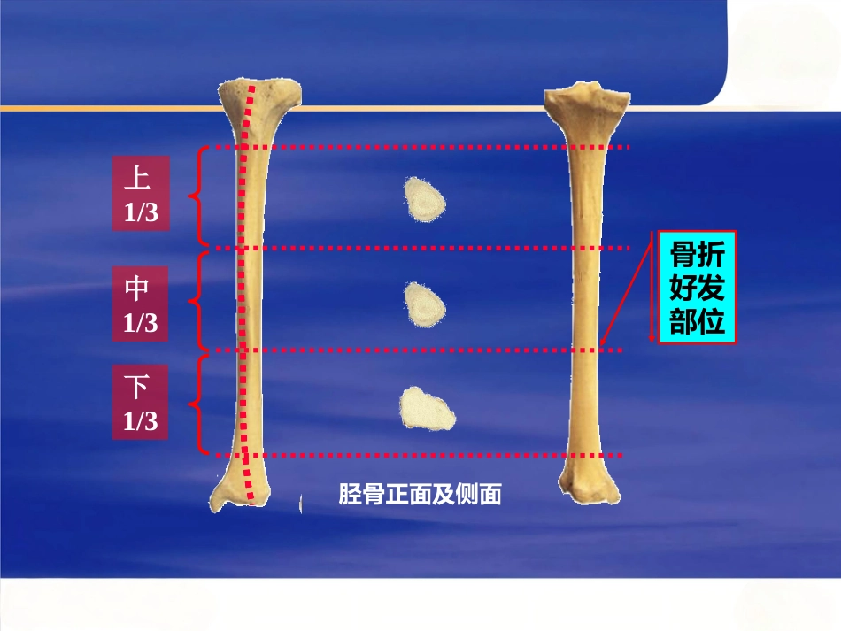 胫腓骨骨折_第6页