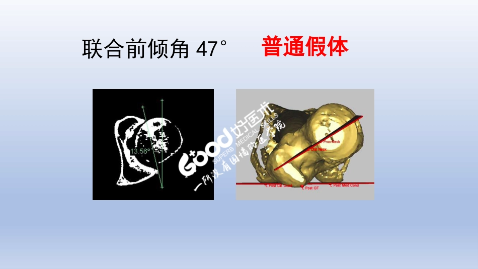 DDH全髋关节置换 手术难点及对策_第13页