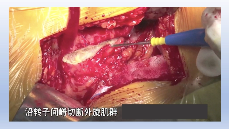 DDH全髋关节置换 手术难点及对策_第15页