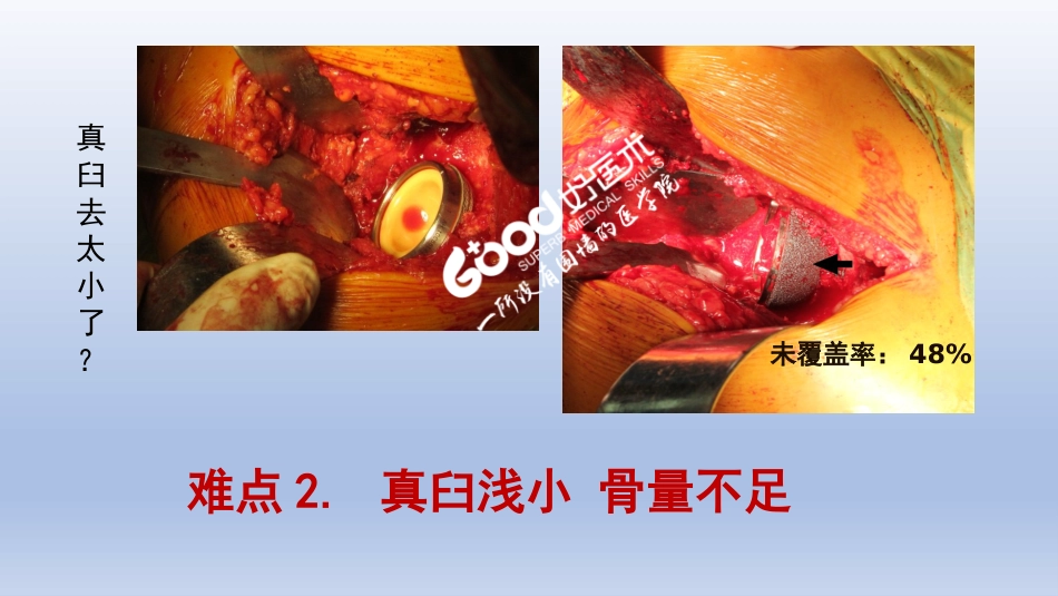 DDH全髋关节置换 手术难点及对策_第5页