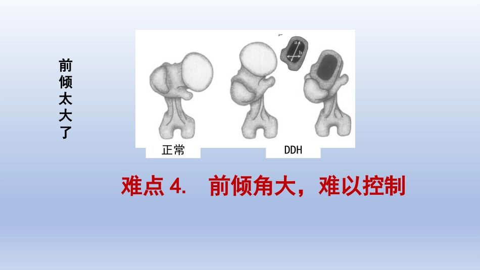 DDH全髋关节置换 手术难点及对策_第7页
