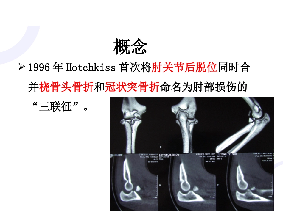 肘关节“恐怖三联征“_第2页