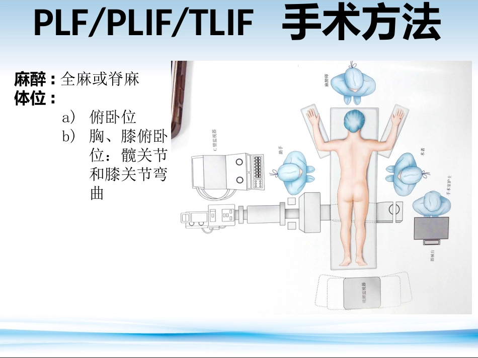 PLF---PLIF--TLIF-ALIF-DLIF-XLIF的技术对比_第4页