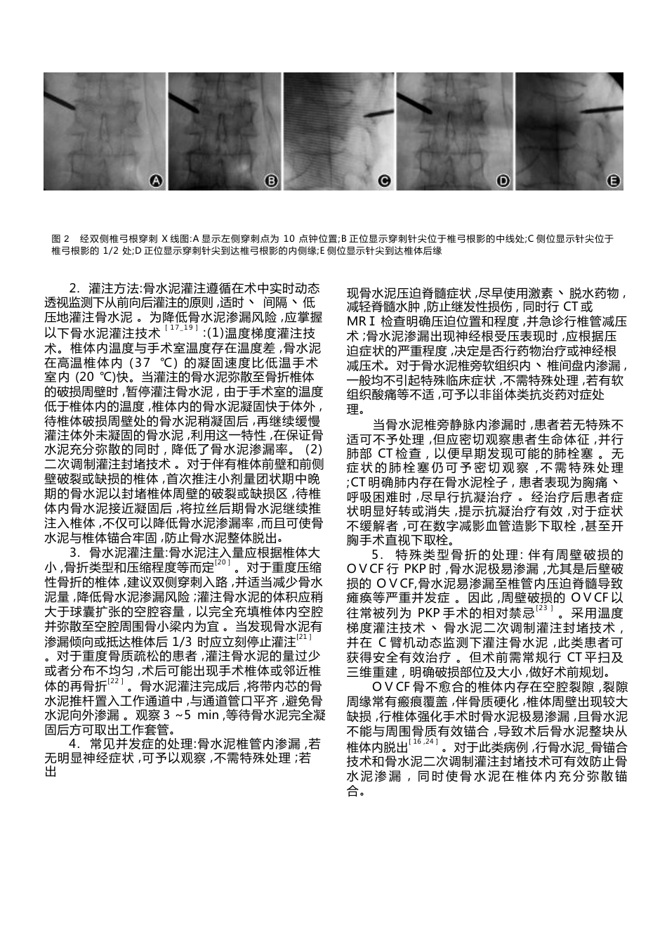 经皮椎体后凸成形术_第3页