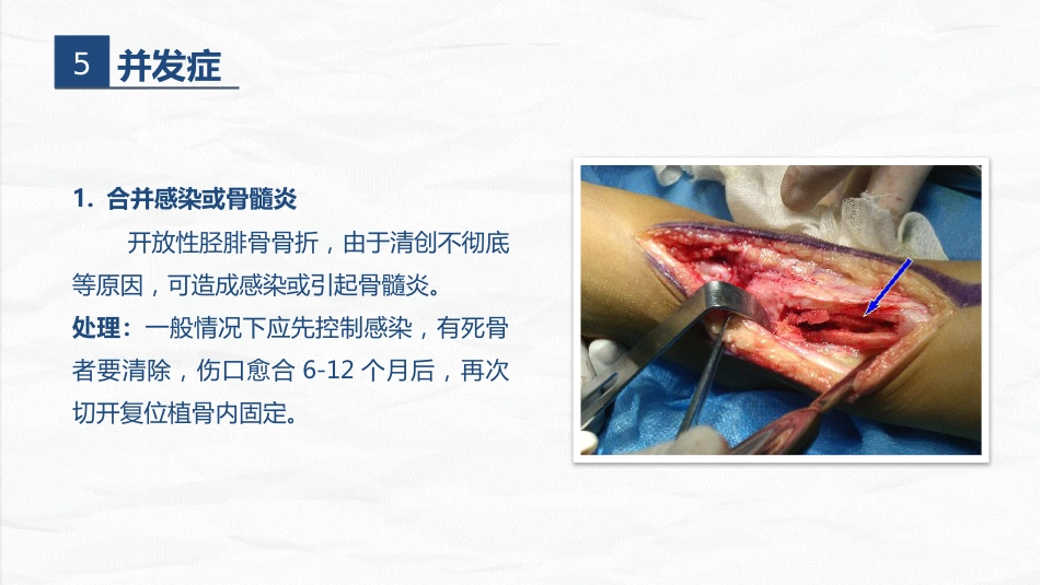 骨科-右胫腓骨远端骨折术合并骨盆骨折的护理查房_第8页